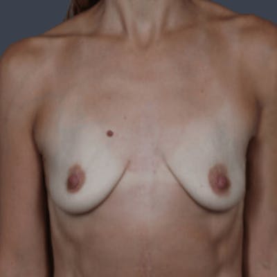Breast Augmentation Before & After Gallery - Patient 407411 - Image 1