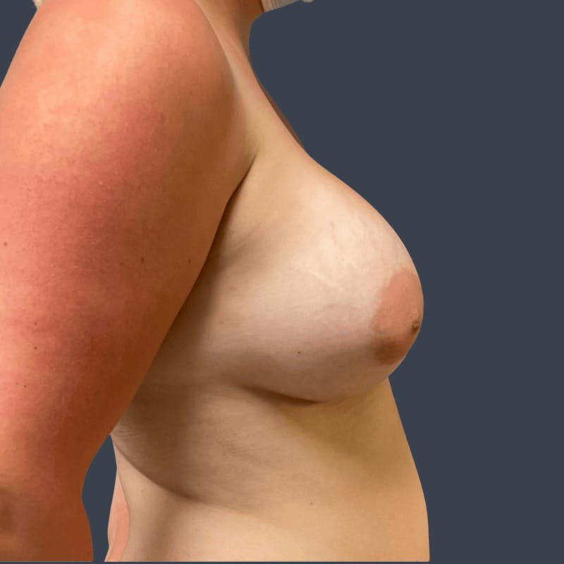 Breast Augmentation Before & After Gallery - Patient 312802 - Image 4