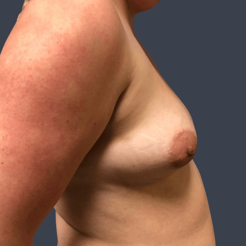 Breast Augmentation Before & After Gallery - Patient 312802 - Image 3