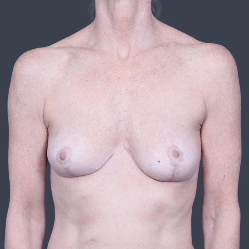 Implant Removal Before & After Gallery - Patient 164208 - Image 2