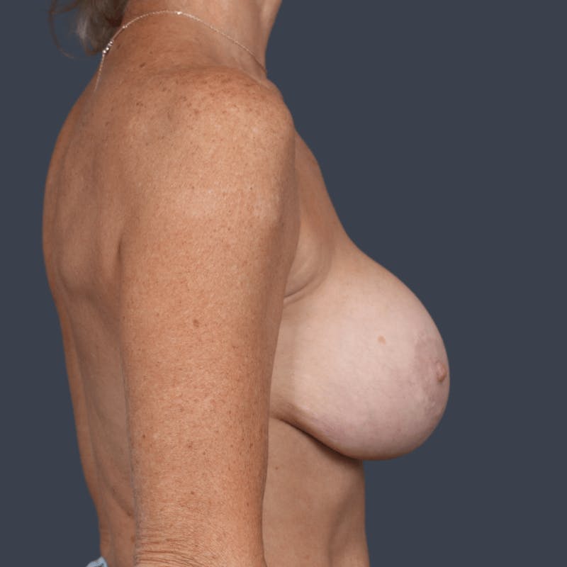 Implant Removal Before & After Gallery - Patient 164208 - Image 5