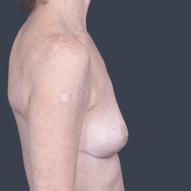 Implant Removal Before & After Gallery - Patient 164208 - Image 6