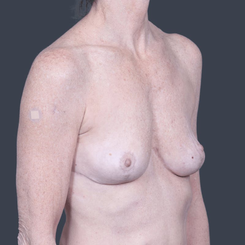 Implant Removal Before & After Gallery - Patient 164208 - Image 4