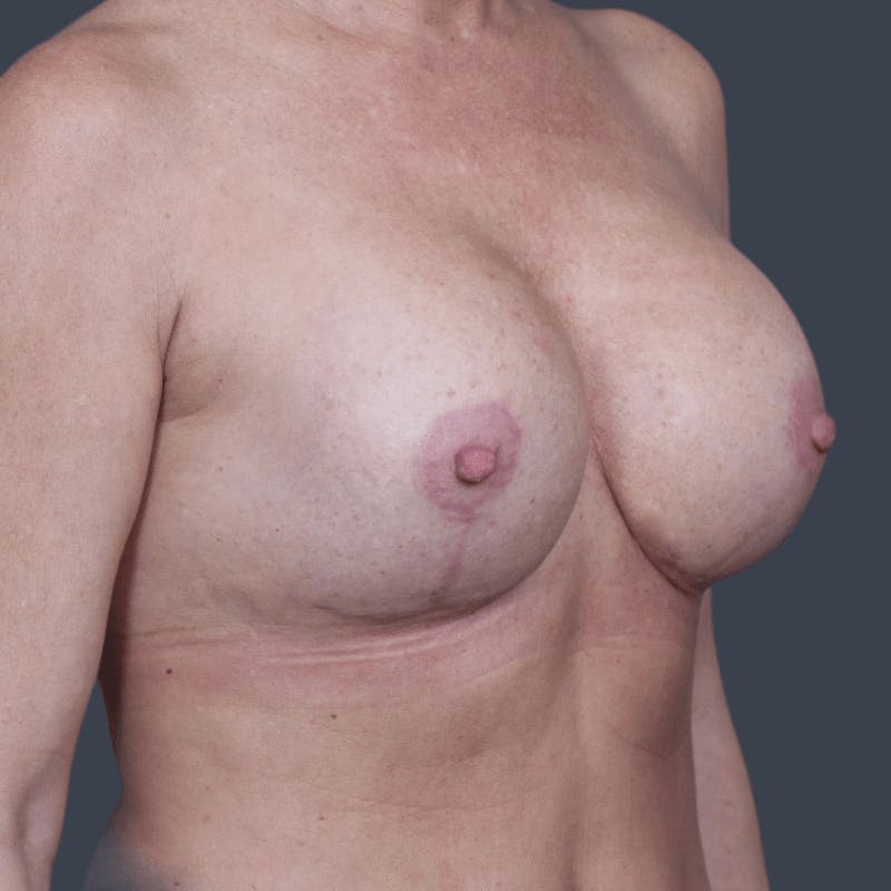 Implant Exchange Before & After Gallery - Patient 401310 - Image 4