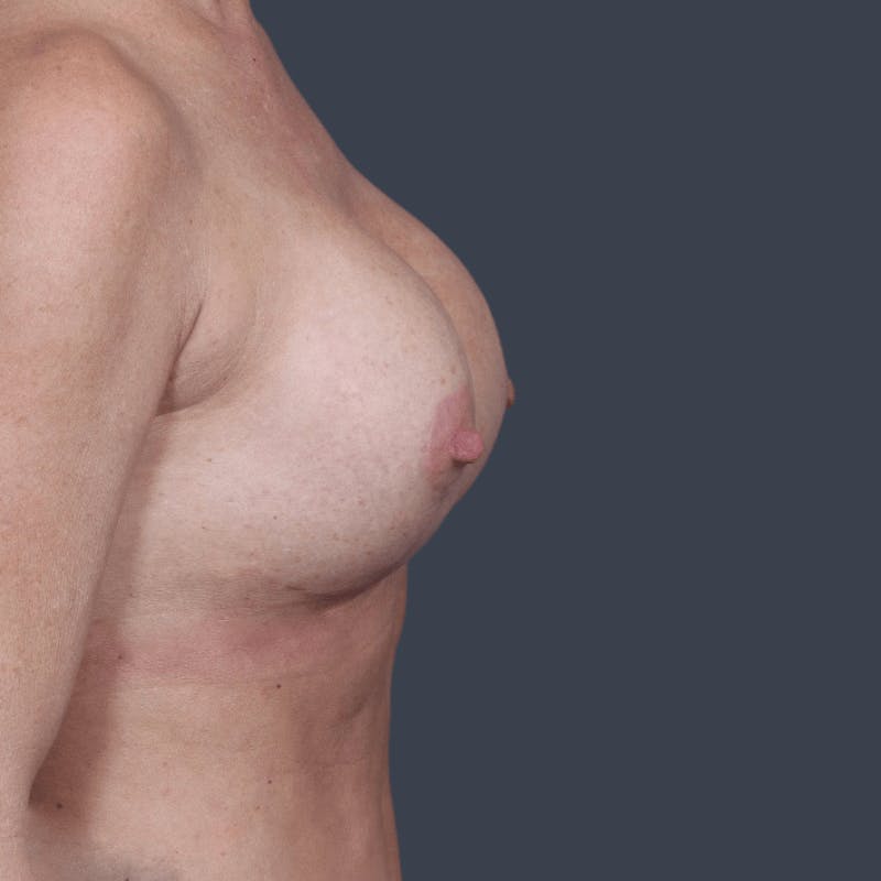 Implant Exchange Before & After Gallery - Patient 401310 - Image 6