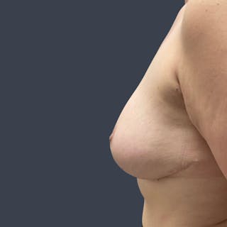 Implant Removal Before & After Gallery - Patient 111537 - Image 6