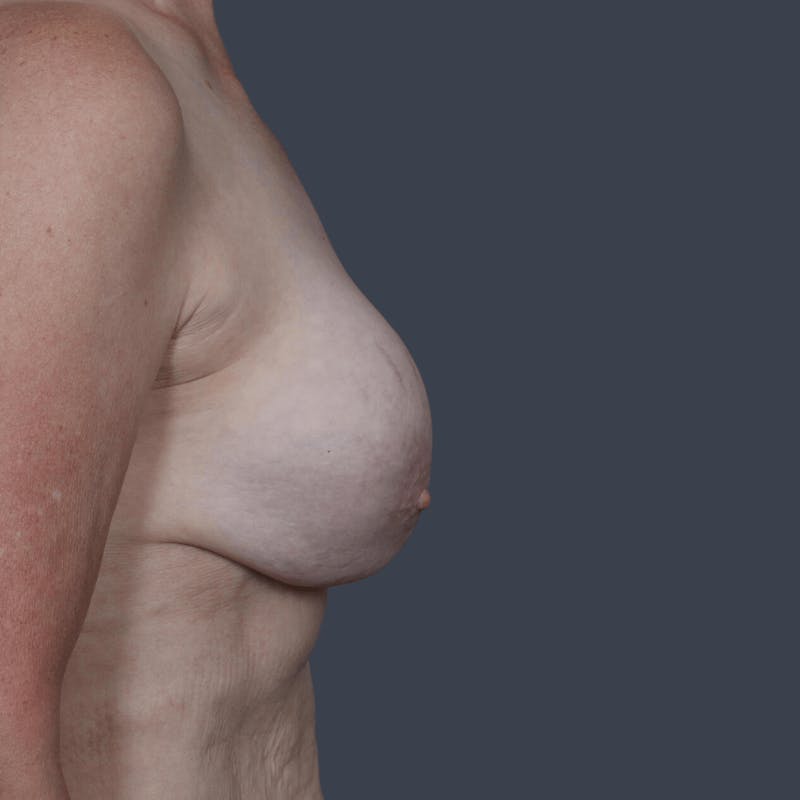 Implant Exchange Before & After Gallery - Patient 604850 - Image 5