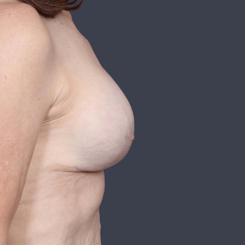 Implant Exchange Before & After Gallery - Patient 604850 - Image 6
