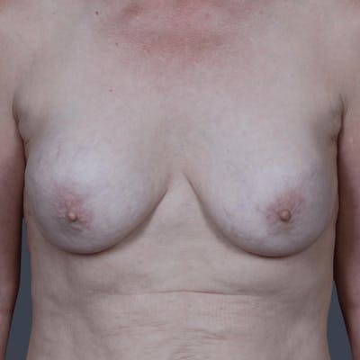 Breast Lift Before & After Gallery - Patient 375089 - Image 1