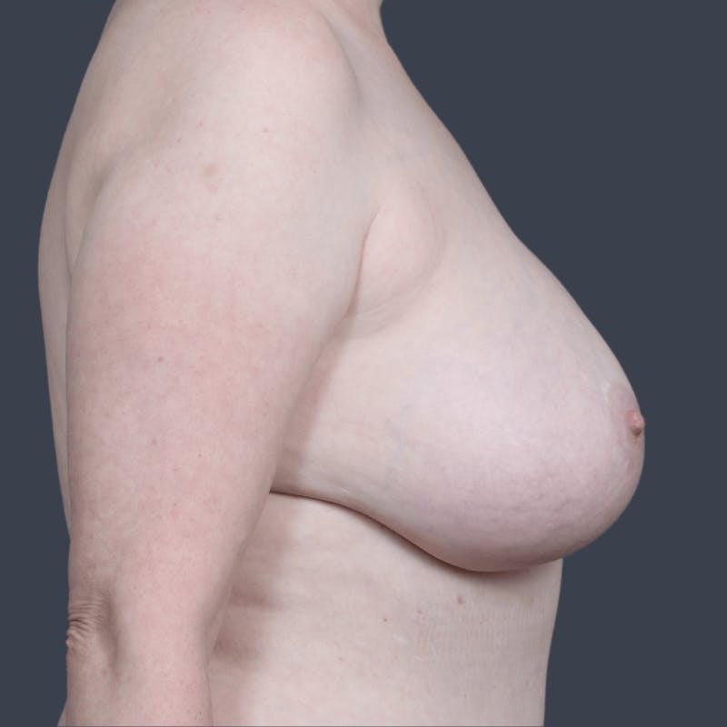 Implant Removal Before & After Gallery - Patient 146629 - Image 5