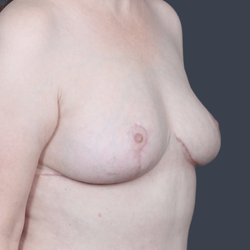 Implant Removal Before & After Gallery - Patient 146629 - Image 4