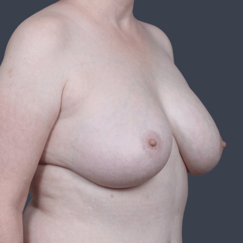 Implant Removal Before & After Gallery - Patient 146629 - Image 3