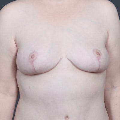 Breast Lift Before & After Gallery - Patient 208417 - Image 2