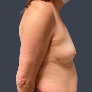 Implant Removal Before & After Gallery - Patient 347448 - Image 4