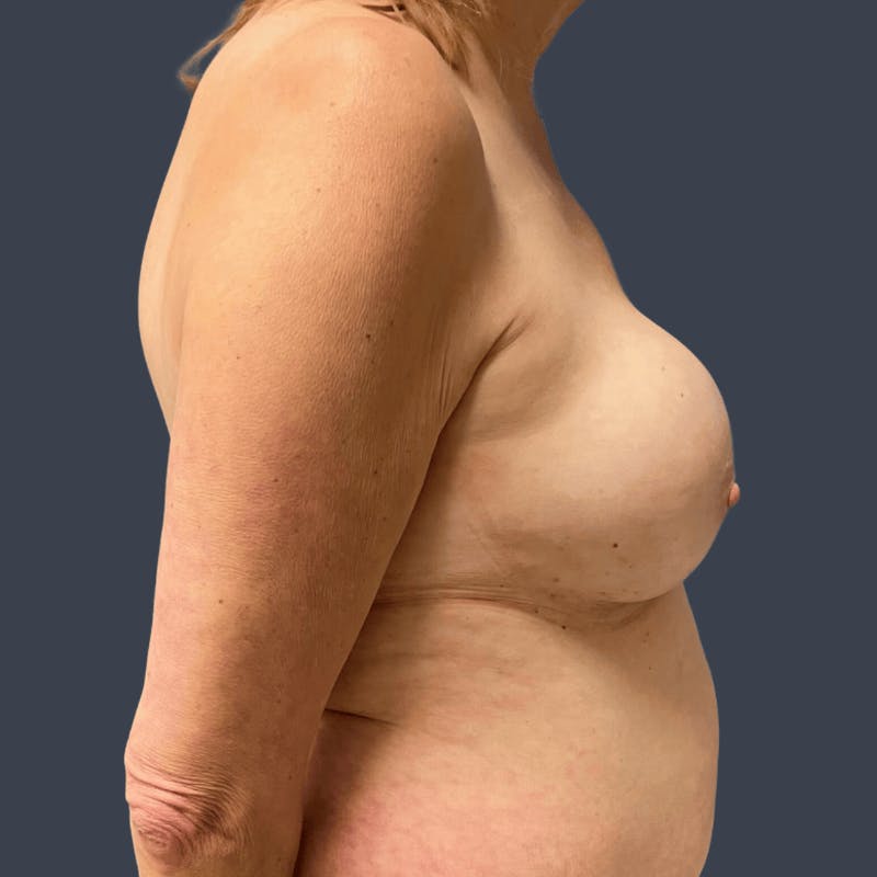 Implant Removal Before & After Gallery - Patient 347448 - Image 3