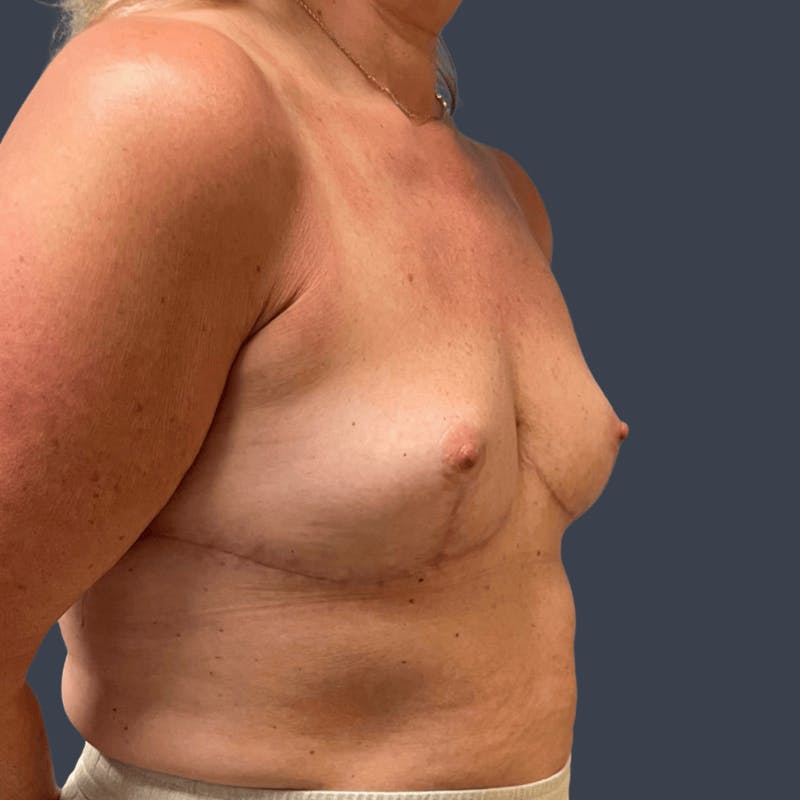 Implant Removal Before & After Gallery - Patient 408529 - Image 4