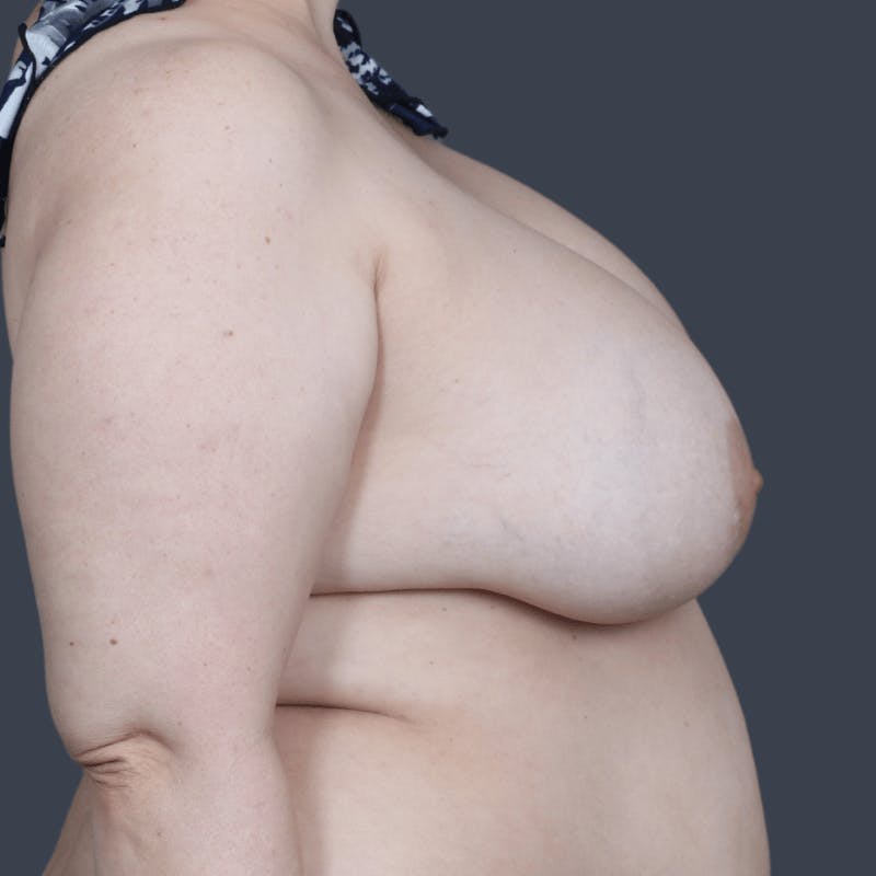 Oncoplastic Breast Reconstruction Before & After Gallery - Patient 231796 - Image 5