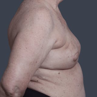 Oncoplastic Breast Reconstruction Before & After Gallery - Patient 102551 - Image 6