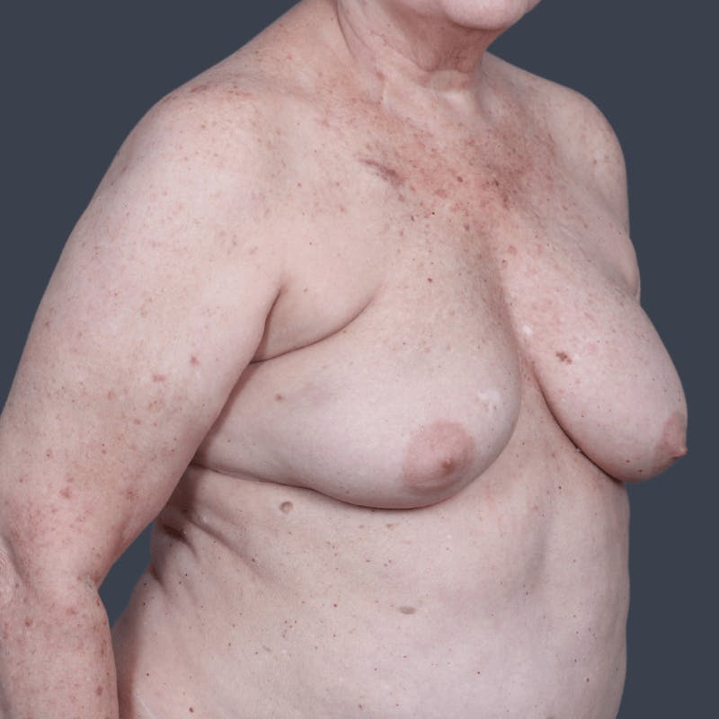 Oncoplastic Breast Reconstruction Before & After Gallery - Patient 102551 - Image 3