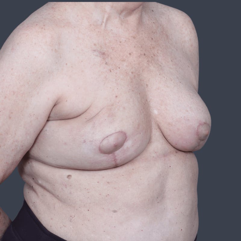 Oncoplastic Breast Reconstruction Before & After Gallery - Patient 102551 - Image 4