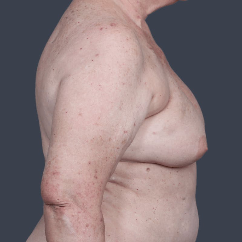 Oncoplastic Breast Reconstruction Before & After Gallery - Patient 102551 - Image 5