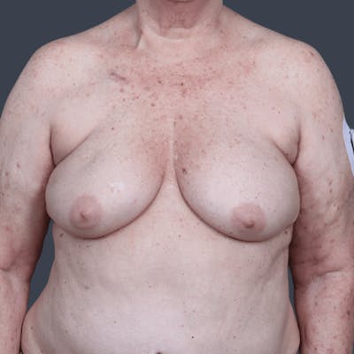 Oncoplastic Breast Reconstruction Before & After Gallery - Patient 102551 - Image 1
