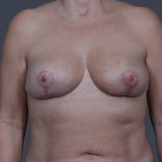 Oncoplastic Breast Reconstruction Before & After Gallery - Patient 242158 - Image 2