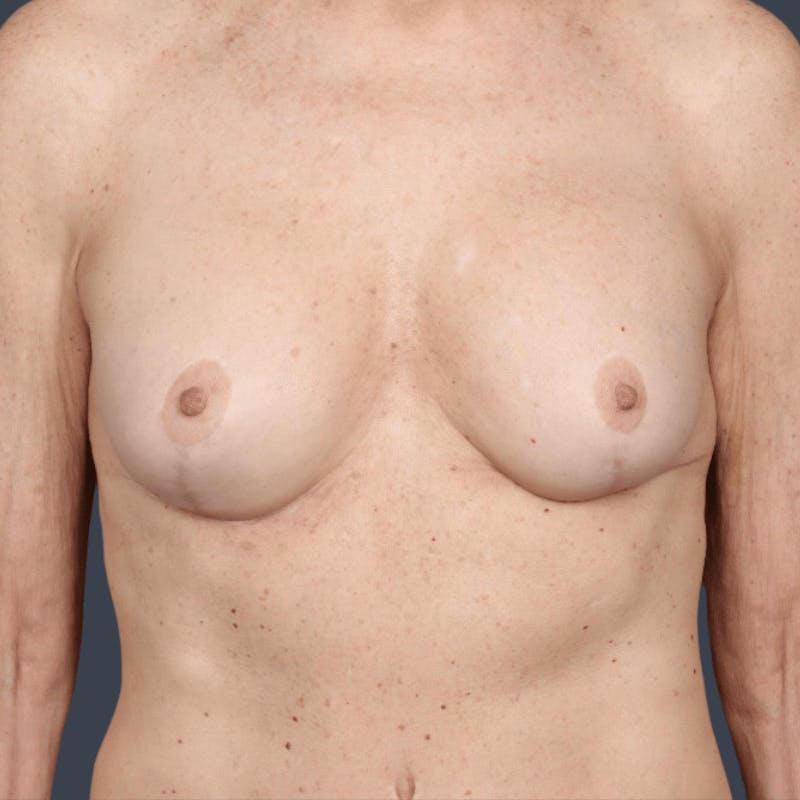 Oncoplastic Breast Reconstruction Before & After Gallery - Patient 880178 - Image 2