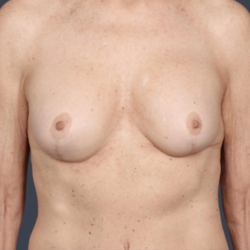 After procedure image for Oncoplastic Breast Reconstruction