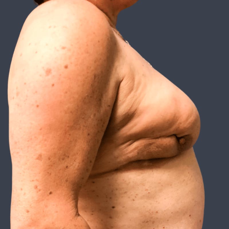 Latissimus Dorsi Flap Before & After Gallery - Patient 296939 - Image 4