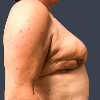 Hybrid Breast Reconstruction Before & After Gallery - Patient 404774 - Image 4