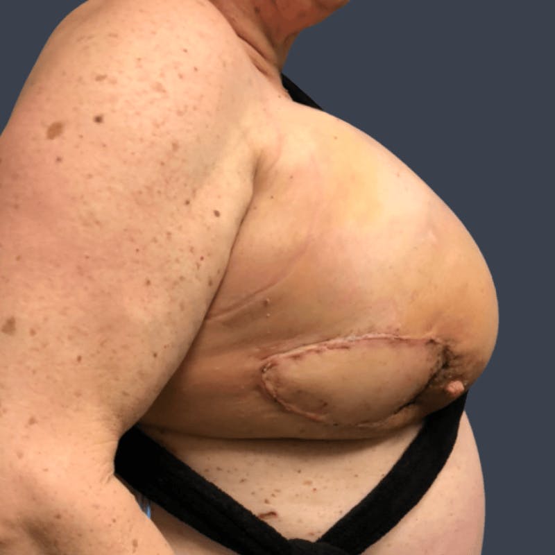 Latissimus Dorsi Flap Before & After Gallery - Patient 296939 - Image 5