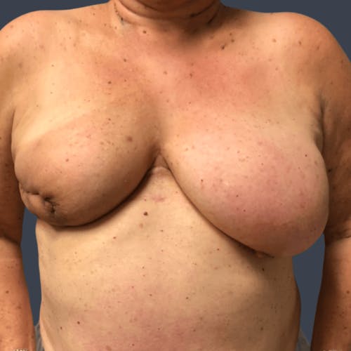 Before procedure image for Hybrid Breast Reconstruction