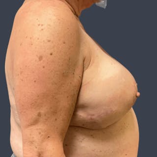 Hybrid Breast Reconstruction Before & After Gallery - Patient 404774 - Image 6