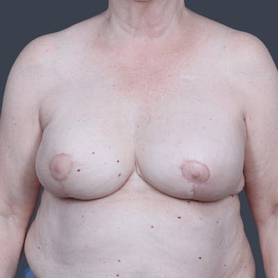 Breast Reconstruction Before & After Gallery - Patient 999053 - Image 2