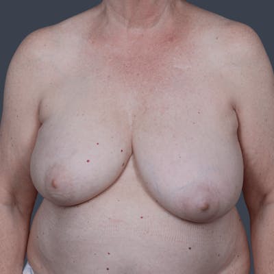 Breast Reconstruction Before & After Gallery - Patient 999053 - Image 1