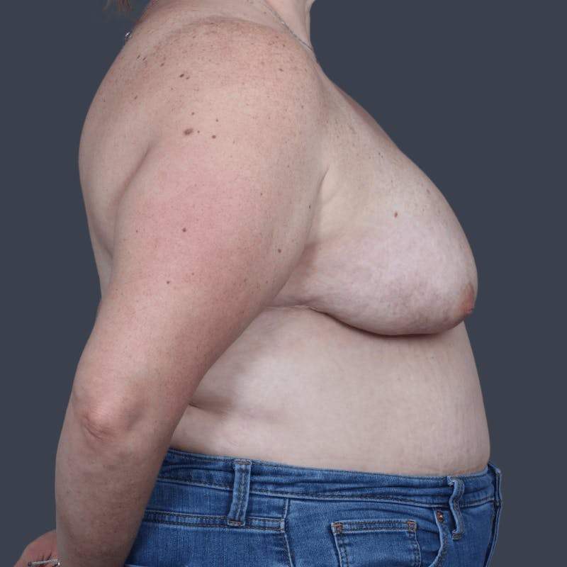 Oncoplastic Breast Reconstruction Before & After Gallery - Patient 108730 - Image 6