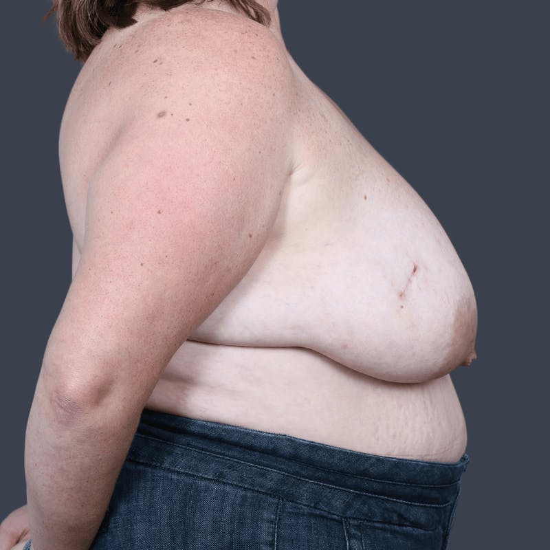 Oncoplastic Breast Reconstruction Before & After Gallery - Patient 108730 - Image 5