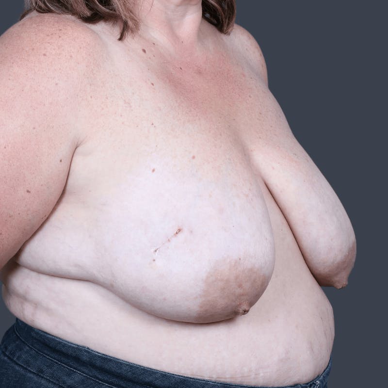 Oncoplastic Breast Reconstruction Before & After Gallery - Patient 108730 - Image 3