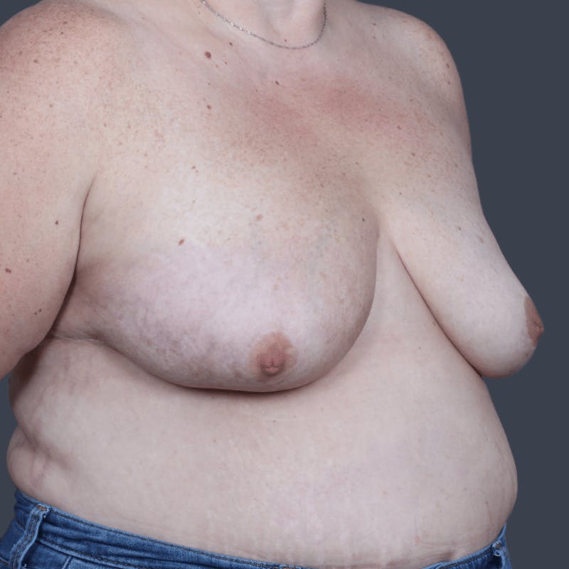 Oncoplastic Breast Reconstruction Before & After Gallery - Patient 108730 - Image 4