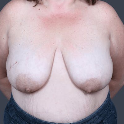 Oncoplastic Breast Reconstruction Before & After Gallery - Patient 390528 - Image 2