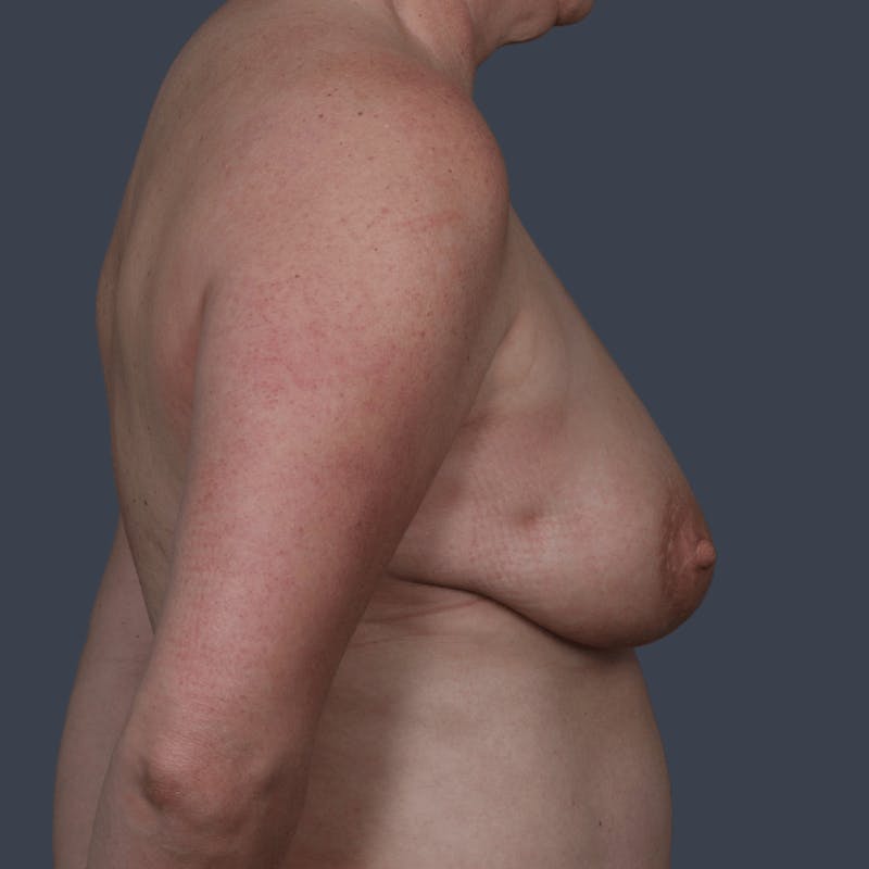 Oncoplastic Breast Reconstruction Before & After Gallery - Patient 156554 - Image 5