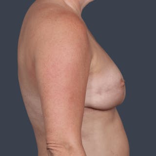 Oncoplastic Breast Reconstruction Before & After Gallery - Patient 156554 - Image 6