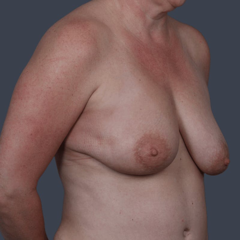 Oncoplastic Breast Reconstruction Before & After Gallery - Patient 156554 - Image 3