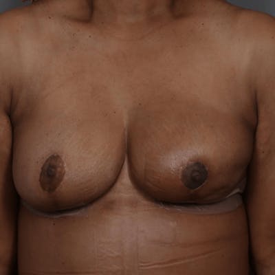 Oncoplastic Breast Reconstruction Before & After Gallery - Patient 193207 - Image 2