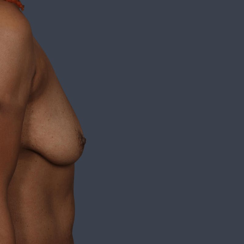 Oncoplastic Breast Reconstruction Before & After Gallery - Patient 193207 - Image 5