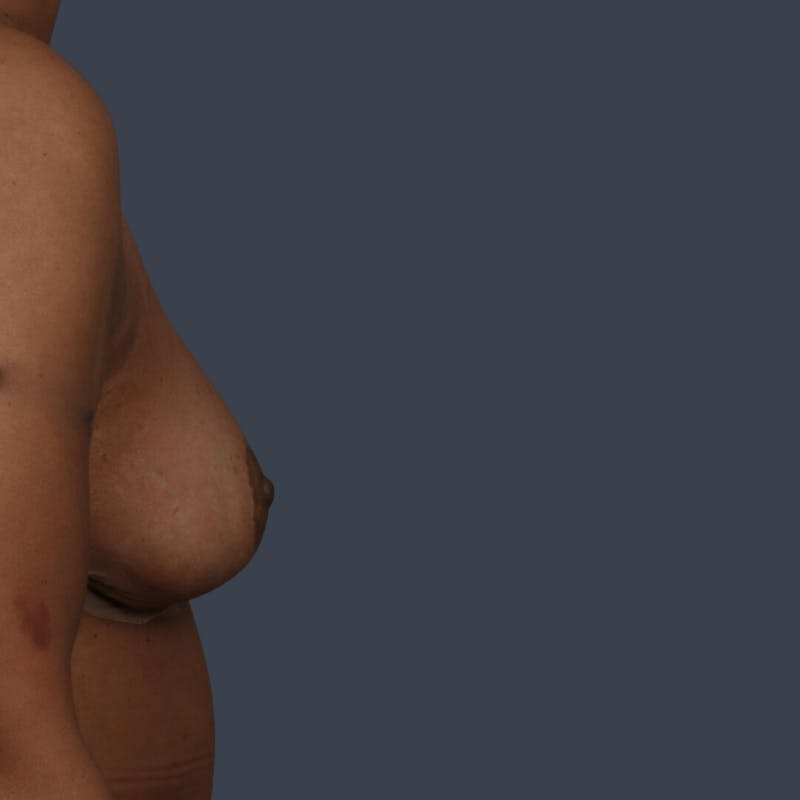 Oncoplastic Breast Reconstruction Before & After Gallery - Patient 193207 - Image 6