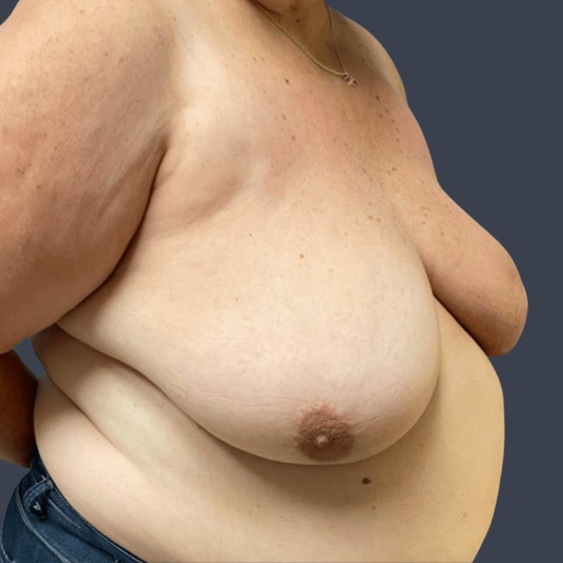 Oncoplastic Breast Reconstruction Before & After Gallery - Patient 407429 - Image 3