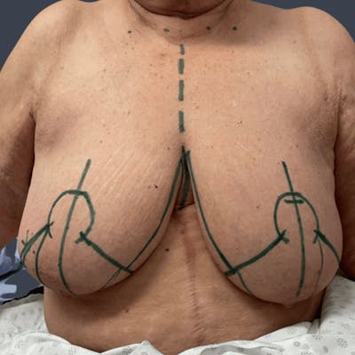 Oncoplastic Breast Reconstruction Before & After Gallery - Patient 136422 - Image 1