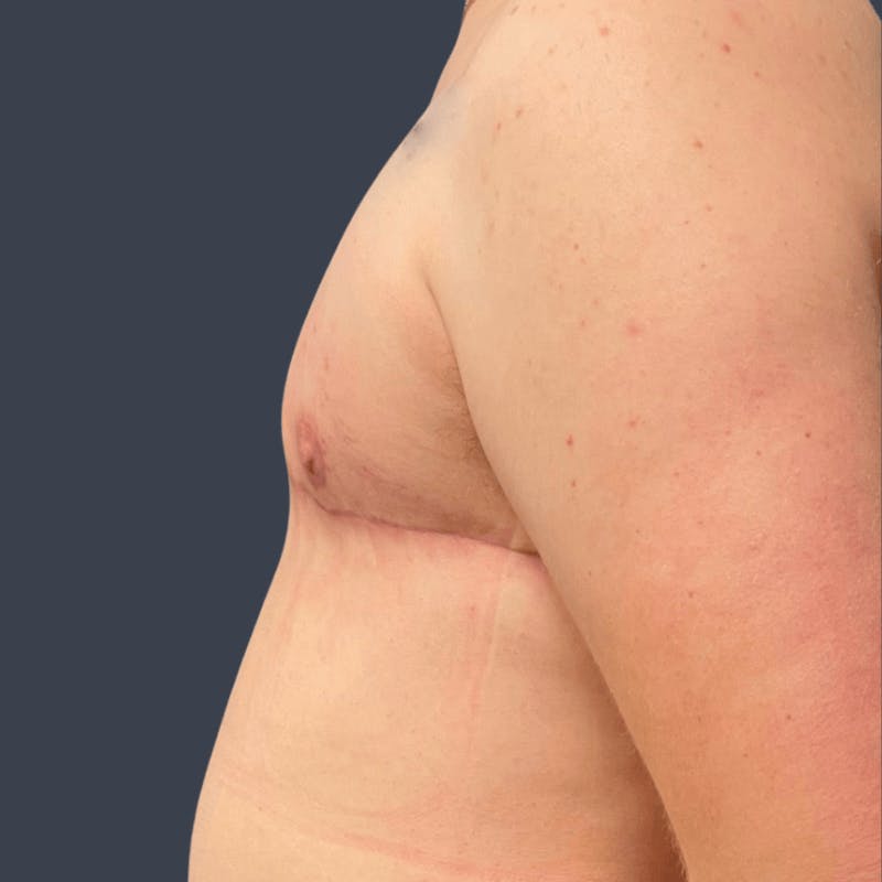 Top Surgery Before & After Gallery - Patient 437110 - Image 4